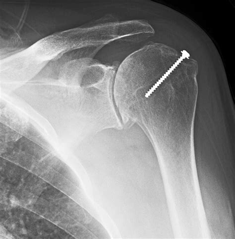 Shoulder Arthritis / Rotator Cuff Tears: causes of shoulder pain: How bad is the shoulder ...