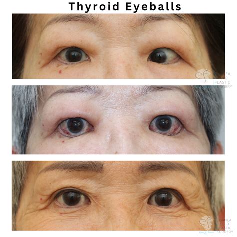 Protruding Eyes Thyroid Progression And Prognosis In Thyroid Eye