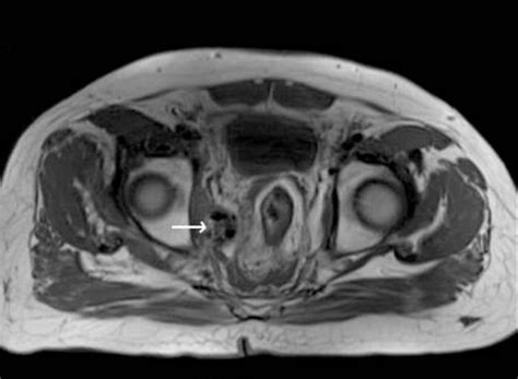 Penatalaksanaan Abses Perianal - Alomedika