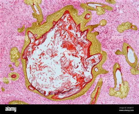 Dermoid ovarian cyst. Light micrograph of a section through an ovary showing a dermoid, or ...