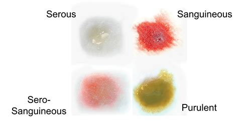 Serosanguinous Vs Sanguineous