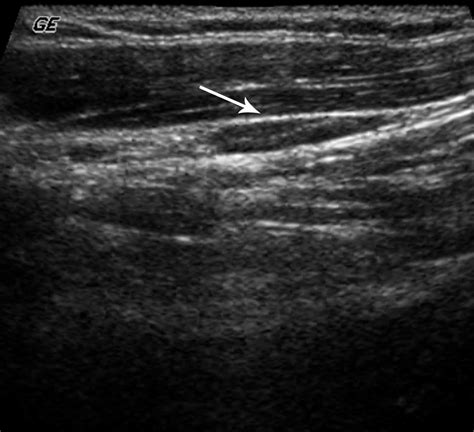 Groin Lymph Nodes Ultrasound