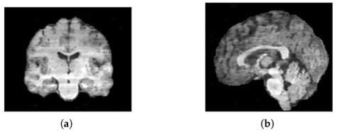 Synthetic MRI Generation from CT Scans for Stroke Patients