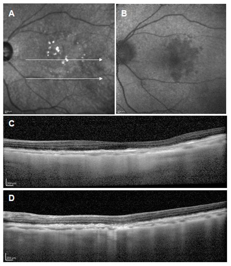 Early Stages of Age-Related Macular Degeneration: Racial/Ethnic ...
