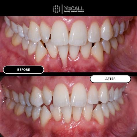 Reverse Gum Recession