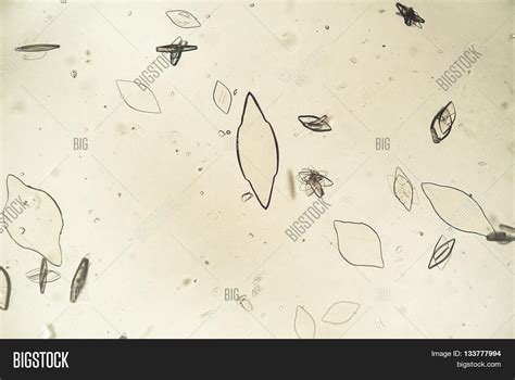 Uric Acid Crystals Image & Photo (Free Trial) | Bigstock
