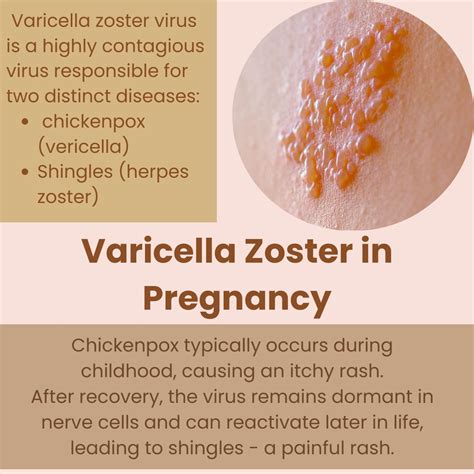 Varicella zoster infection risks pregnant women and babies | Javeria ...