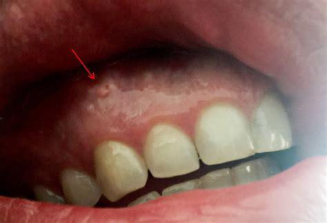 White Bump On Gums No Pain | Renew Physical Therapy