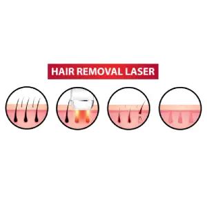 Laser Hair Removal Cost in India - Get Price Estimate