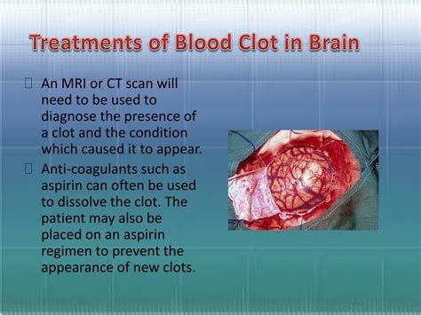 PPT - Blood Clots in Brain PowerPoint Presentation, free download - ID ...