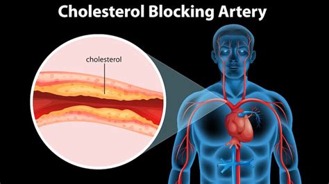 Stent Purpose Treatment Complications Recovery | OnlyMyHealth