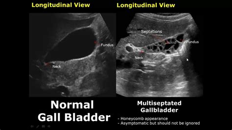 Image result for Normal Gallbladder Function