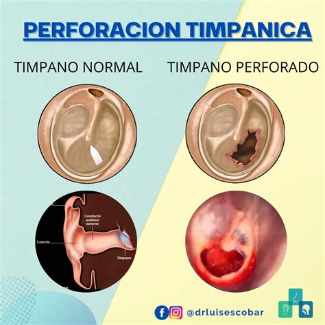 Perfurar O Tímpano é Grave - RETOEDU