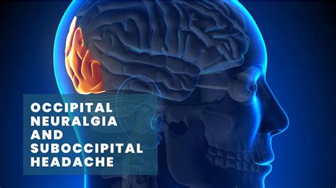 Occipital Neuralgia | Suboccipital Headache | Physiotherapy Treatment