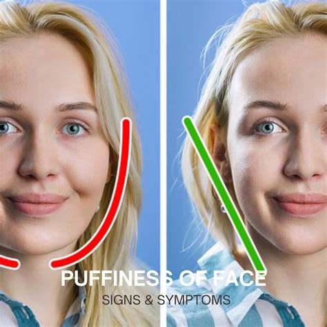 Puffiness of the Face: Causes, Treatments, and Prevention