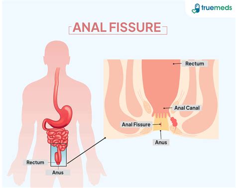 Anal Fissure: Causes, Symptoms, Diagnosis & Treatment Guide