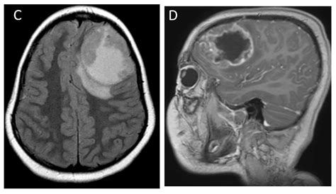 Brain Tumor Mri Without Contrast