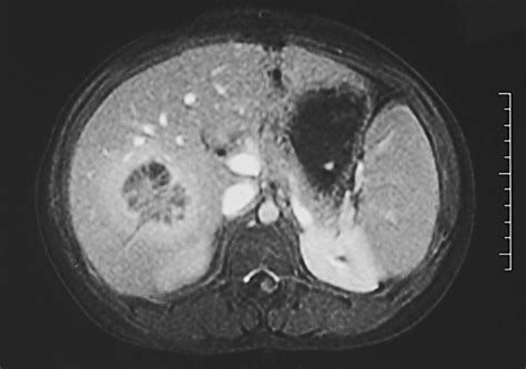 CT and MRI of Hepatic Abscess in Patients with Chronic Granulomatous ...