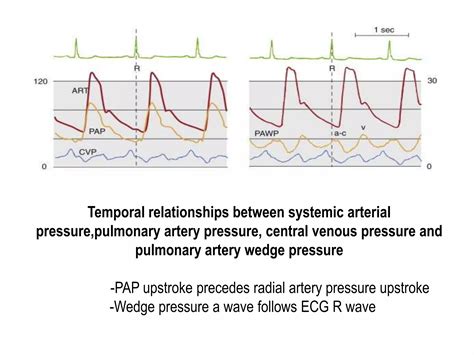 Pulmonary artery-catheter2 | PPTX