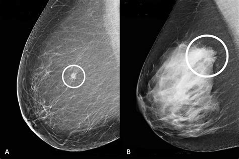 Breast Cancer Mammogram