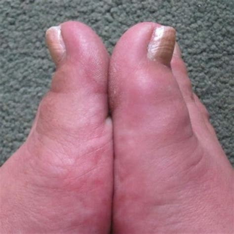 5 Facts About Gout