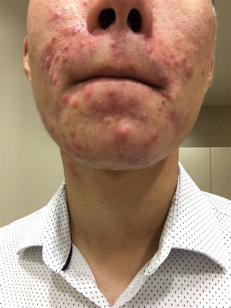 Face Breaking Out Around Mouth at Brenda Norris blog