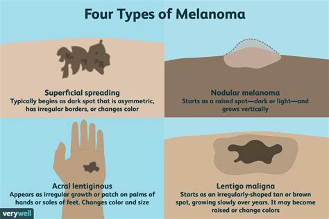 How Quickly Does Melanoma Spread