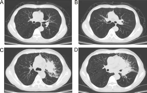 A and B show the CT scan results 2 months after treatment. C and D show... | Download Scientific ...