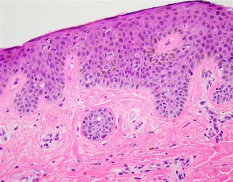 Dysplastic Nevus Histology