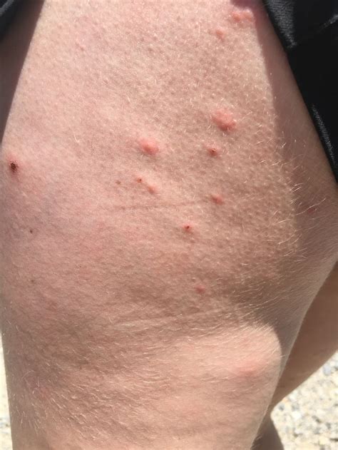 Medical: Scabies Reported Along Southern Virginia AT - The Trek ...