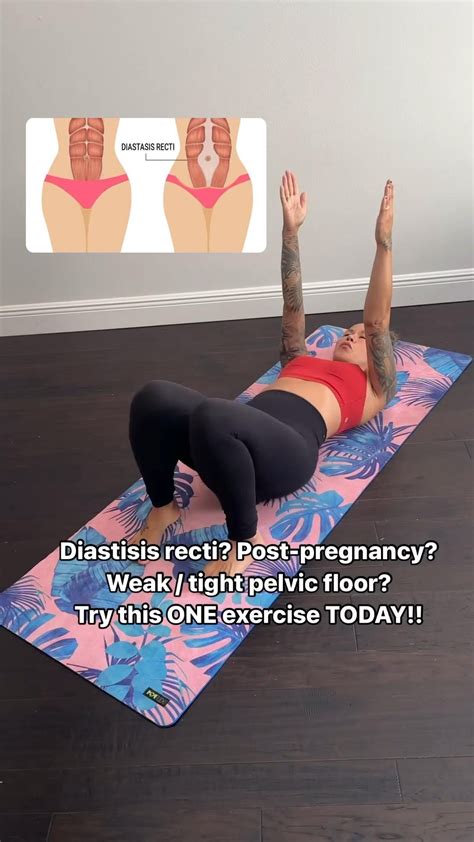 Healing diastasis recti – Artofit