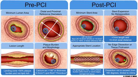 SCAI Expert Consensus Statement on the Management of Patients With STEMI Referred for Primary ...