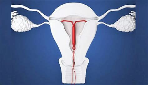 Image result for UID Family Planning