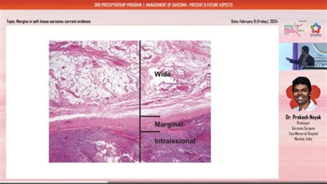 Advanced Centre for Treatment Research & Education in Cancer