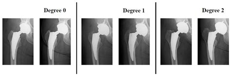 Stress Shielding Radiology Hip at Todd Stclair blog