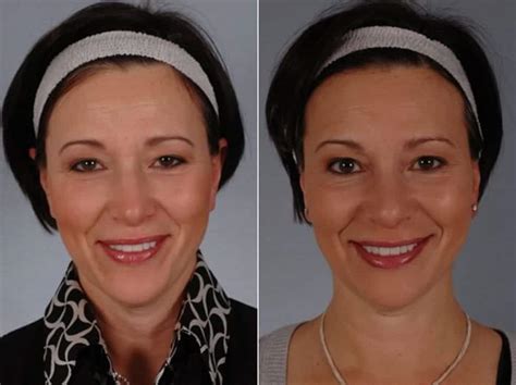 What Botox Looks Like After Years of Use, According to Derms