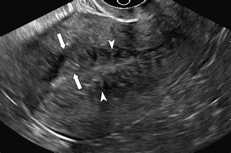 Adenomyosis: A Sonographic DiagnosisRadioGraphics