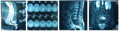 Figure 2: Preoperative CT scan (A) and MRI (B) displaying the L5-S1 ...