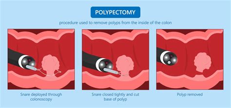 Image result for Polypectomy Recovery