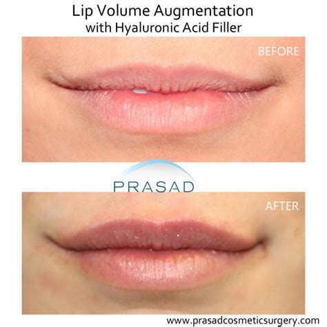 How to Avoid Bad Lip Filler Results | Dr. Prasad Blog | New York