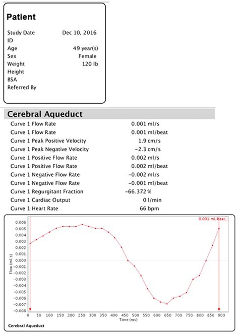 Aliasing CSF Flow MRI 的图像结果