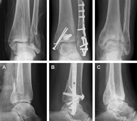 Fracture Of The Posterior Malleolus