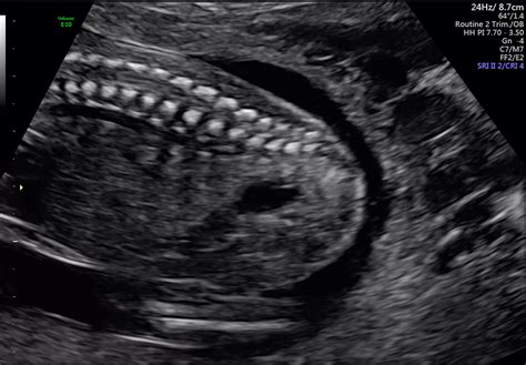 20 Weeks Pregnant Ultrasound