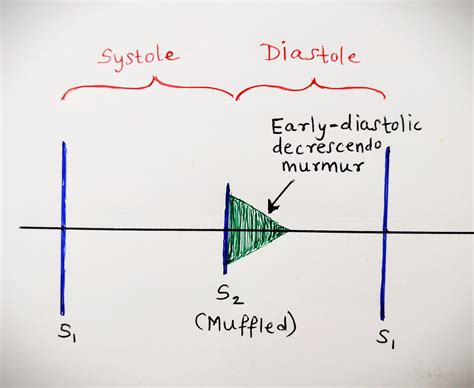 Aortic Regurgitation Murmur