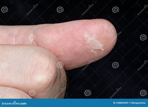 Hand Callus Pictures at Frank Keith blog