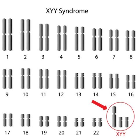 XYY syndrome causes, symptoms, life expectancy, prognosis & treatment