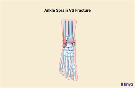 Sprained vs. Broken Ankle: Know the Difference & Find Relief Fast – Knya