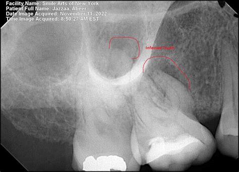 Tooth Abscess Xray