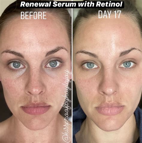 New renewal serum with Retinol! | Retinol for skin, Skincare, Oily sensitive skin