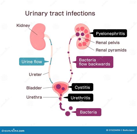 Urinary Tract Infection Illustration Stock Vector - Illustration of fanconi, symptoms: 315224494